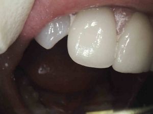Cosmetic Contouring- Before