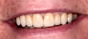 porcelain-veneer-after